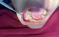 Bé 12 tuổi phải nhập viện vì biến chứng nang xương hàm