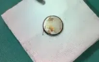 Nội soi gắp viên pin trong thực quản bé 3 tuổi