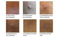 Vaccine có hiệu quả chống lại bệnh đậu mùa khỉ đến 85%