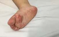 Bệnh tay chân miệng diễn biến phức tạp, có thể gia tăng thời gian tới