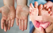 Hơn 5.500 ca mắc tay chân miệng trong 5 tháng đầu năm