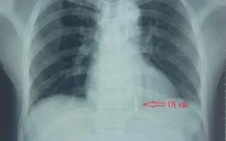 Dùng máy cắt cỏ cắt hàng rào kẽm gai bị dị vật dài 4cm xuyên vào buồng tim