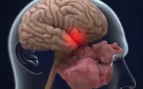 Người mắc COVID-19 thể nặng bị mất tới 10 điểm IQ