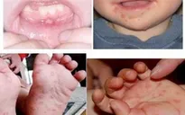 Trong 1 tuần, Đà Nẵng ghi nhận hơn 100 trẻ mắc tay chân miệng