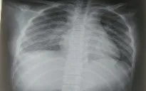 Bé gái nguy kịch sau 2 tuần khỏi COVID-19