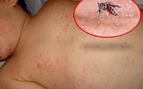 Bé trai 12 tuổi tử vong do mắc sốt xuất huyết tại Đắk Lắk