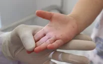 Những sai lầm khiến trẻ mắc tay chân miệng trở nặng