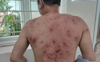 Tin vào quảng cáo "thuốc nam sạch" của thầy lang - bệnh nhân bị bùng phát vảy nến toàn thân