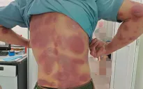 Dị ứng nặng do tự mua thuốc điều trị