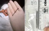 Bị đinh sắt dài 5cm đâm xuyên hốc mắt khi căng dây đóng cốt pha