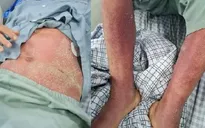 2 bệnh nhân bị viêm màng não, nhiễm khuẩn huyết do liên cầu lợn
