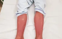 6 biến chứng nguy hiểm của sốt xuất huyết Dengue