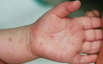 Số ca mắc tay chân miệng ở Đồng bằng sông Cửu Long tăng đột biến