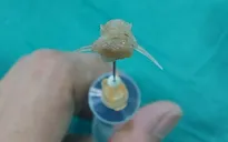 Gắp mảnh xương cá sắc nhọn trong thanh quản bé 2 tuổi