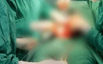 Bóc tách khối u xơ "trú ẩn" nhiều năm trong cơ thể người phụ nữ Lào