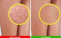 6 cách tự cải thiện làn da viêm nang lông tại nhà
