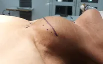 Phẫu thuật bướu giáp chiếm toàn bộ vùng cổ bệnh nhân