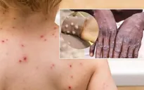WHO ban bố tình trạng khẩn cấp y tế toàn cầu về bệnh đậu mùa khỉ, Bộ Y tế họp khẩn