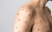 Mỹ ghi nhận trường hợp mắc COVID-19 và đậu mùa khỉ cùng lúc