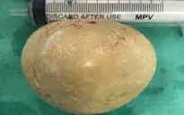 Lấy viên sỏi to như quả trứng trong bàng quang nam bệnh nhân
