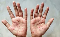 Bộ Y tế: Tăng cường phòng, chống bệnh đậu mùa khỉ tại Đắk Lắk