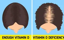 6 dấu hiệu "cảnh báo" cơ thể bạn đang thiếu Vitamin D trầm trọng