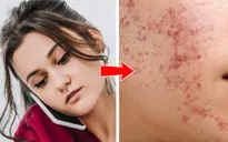 Mụn mọc tại 8 vị trí này bắt nguồn từ các thói quen nhiều người mắc