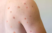 Cần làm gì khi mắc bệnh đậu mùa khỉ hoặc tiếp xúc gần người bệnh?
