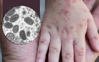 Chưa có thuốc đặc trị đậu mùa khỉ nhưng có thể dùng vaccine phòng bệnh