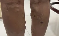 Nhập viện cầu cứu bác sĩ vì tĩnh mạch giãn ngoằn ngoèo dưới da