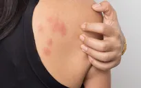 Nghiên cứu mới: Chất xơ trong ruột có thể giúp ích cho các bệnh về dị ứng da