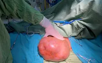 Nhập viện cầu cứu bác sĩ vì khối u vú nặng gần 5kg