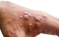 Canada đẩy mạnh tiêm vaccine phòng đậu mùa khỉ