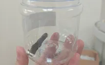 Cành cây dài 6,5 cm nằm trong phổi chàng trai người Mông suốt 14 năm