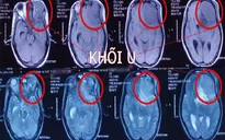 8 giờ phẫu thuật khối u não cho sản phụ thai 22 tuần tuổi