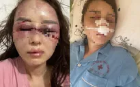 Công an vào cuộc vụ cán bộ QLTT đánh bạn gái vì hát song ca với người khác