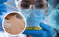 Chi tiết hướng dẫn phòng bệnh đậu mùa khỉ