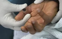 Châu Mỹ có tỷ lệ mắc bệnh đậu mùa khỉ cao nhất thế giới