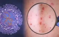 Brazil cấp phép vaccine phòng bệnh đậu mùa khỉ