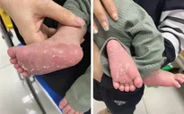 Ngỡ ngàng phát hiện con mới 46 ngày tuổi đã mắc bệnh... giang mai
