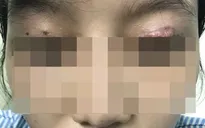 Bị tổn thương mắt vì thẩm mỹ chui