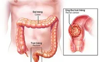 Thử nghiệm thiết bị phát hiện sớm ung thư trực tràng