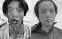 Người phụ nữ bị suy thận cấp, tổn thương da nặng do tự ý dùng thuốc