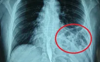 Tưởng hậu COVID-19, đi khám phát hiện bị vỡ cơ hoành