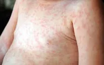 Chăm sóc trẻ mắc sốt xuất huyết Dengue tại nhà