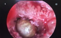 Bác sĩ gắp được ve chó còn sống trong... tai bé gái 2 tuổi