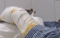 Liên tiếp nhiều bệnh nhân bị bỏng do pháo tự chế