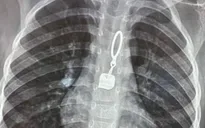 Đưa con đi khám vì đau họng, bác sĩ phát hiện khóa áo nằm trong thực quản