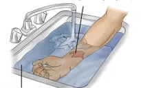 Gần 1/3 số vụ trẻ em bị bỏng nước sôi ở Mỹ là do mì ăn liền