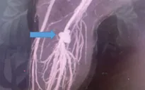 Bị kéo đâm vào chân khi đang chơi, bé trai suýt phải cắt chân